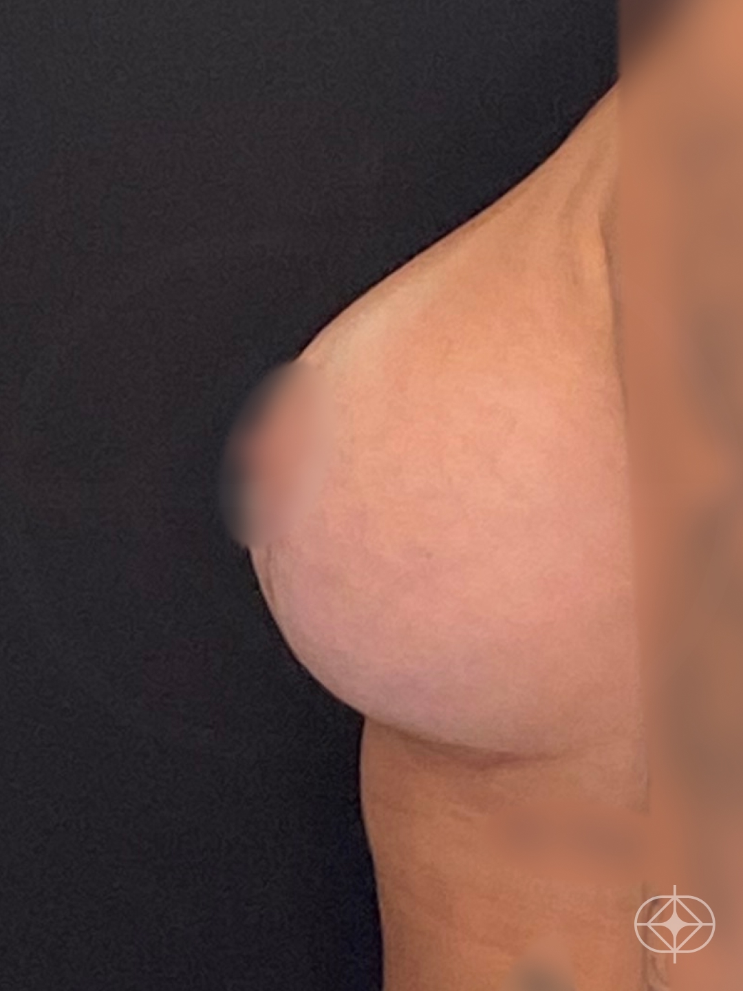 Resultado após Mastopexia com Prótese (silicone) realizado por Dr. Leandro Akio Tomita