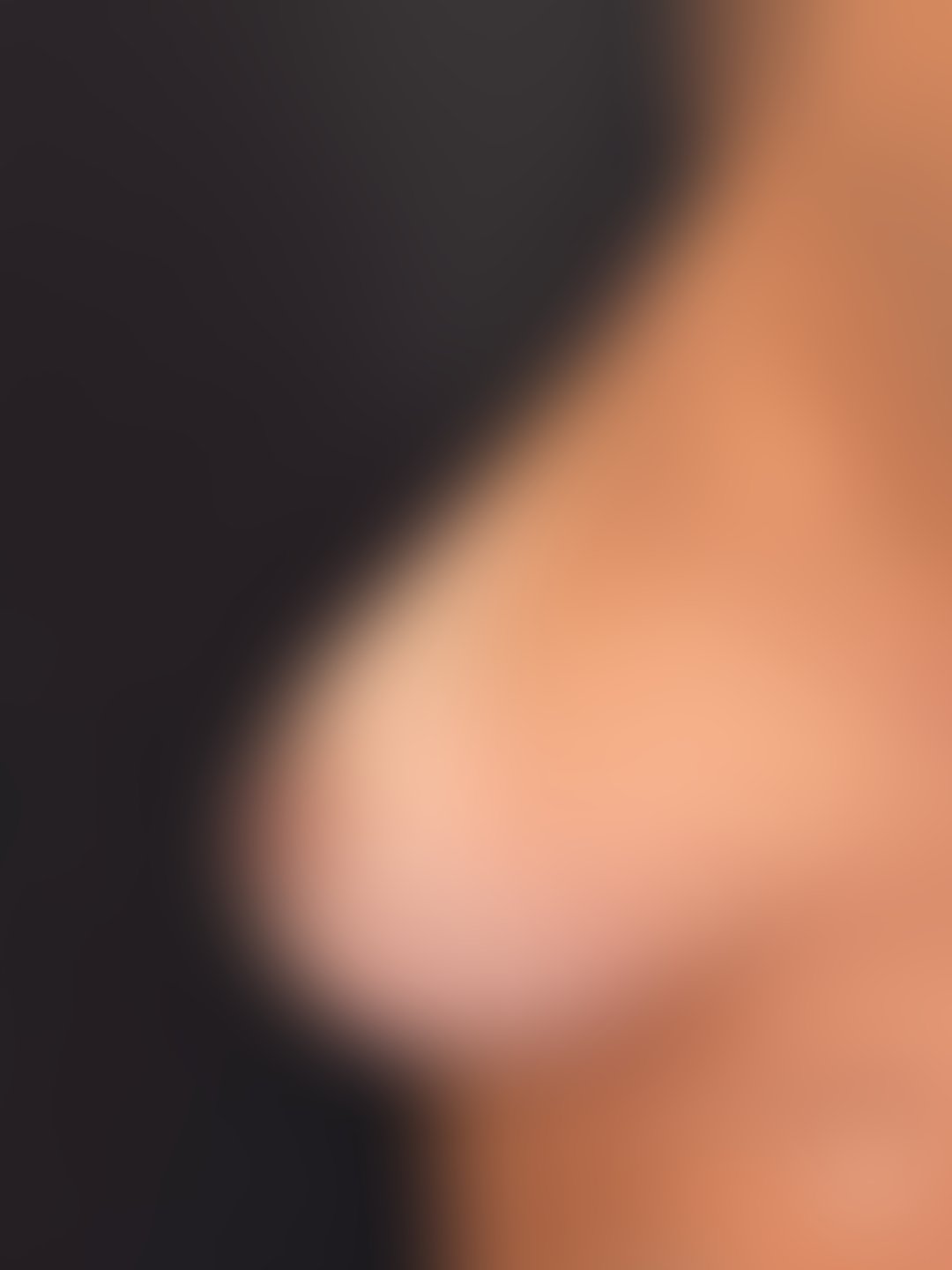 Foto antes de Mastopexia com Prótese (silicone) realizado por Dr. Leandro Akio Tomita