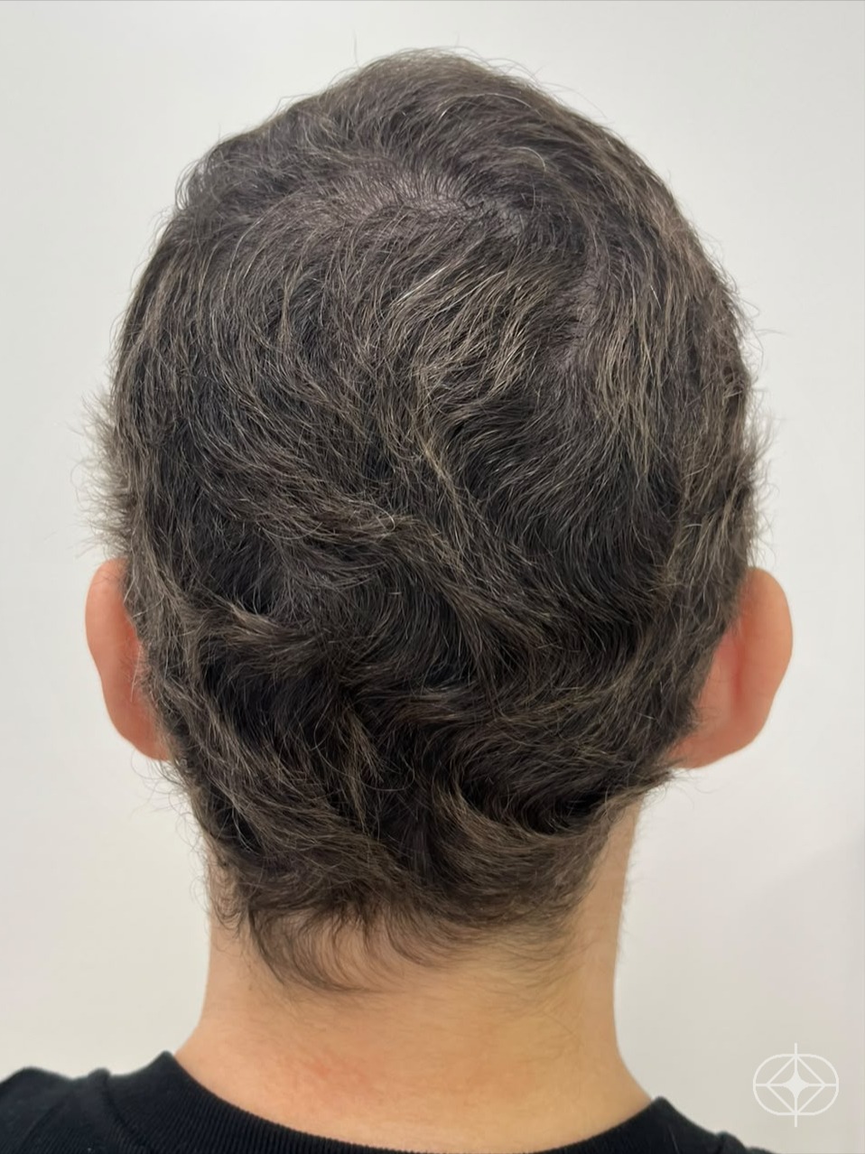 Resultado após Capilar (alopecia, dermatite, psoríase) realizado por Dra. Angélica Seidel