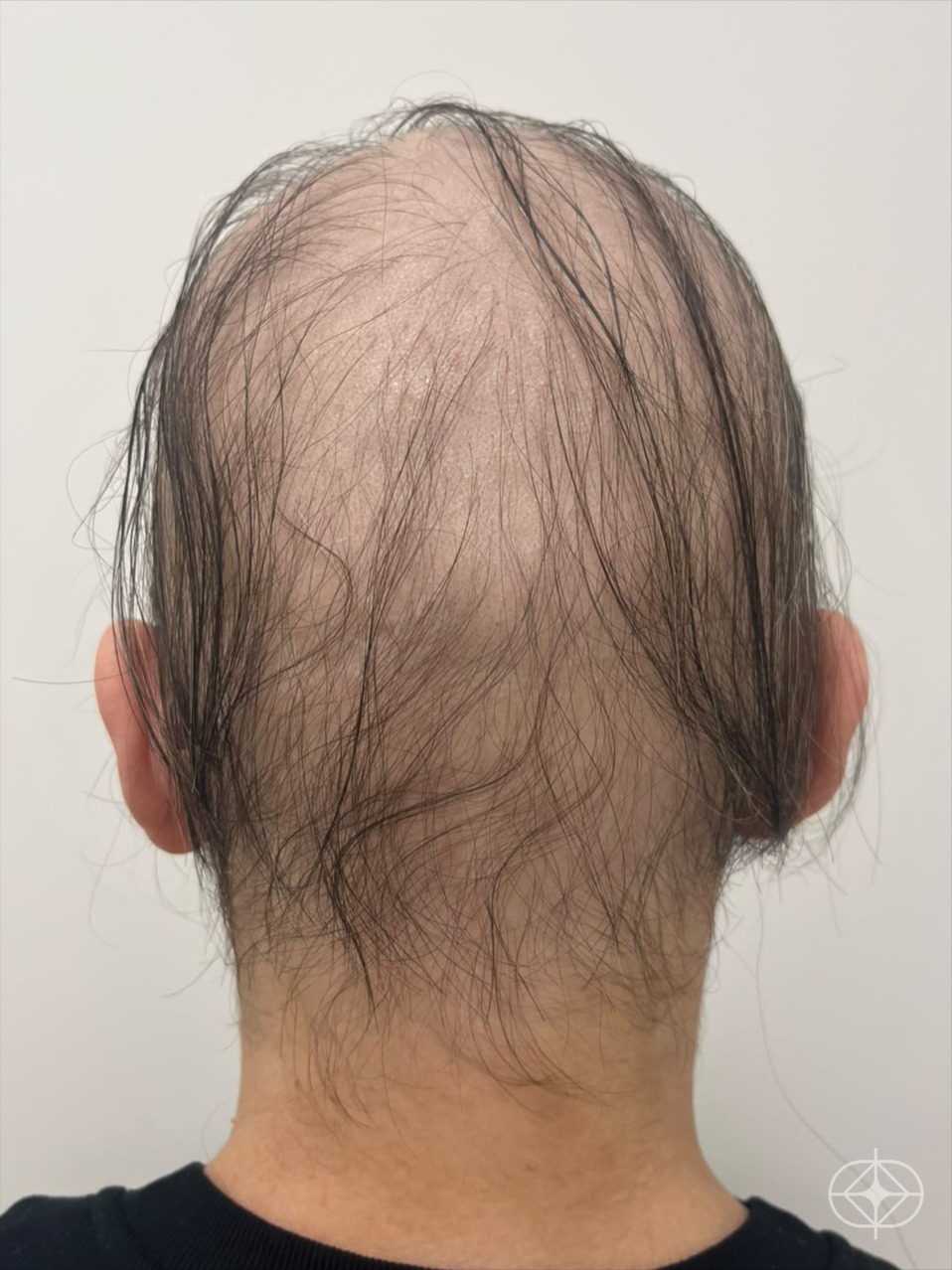 Foto antes de Capilar (alopecia, dermatite, psoríase) realizado por Dra. Angélica Seidel