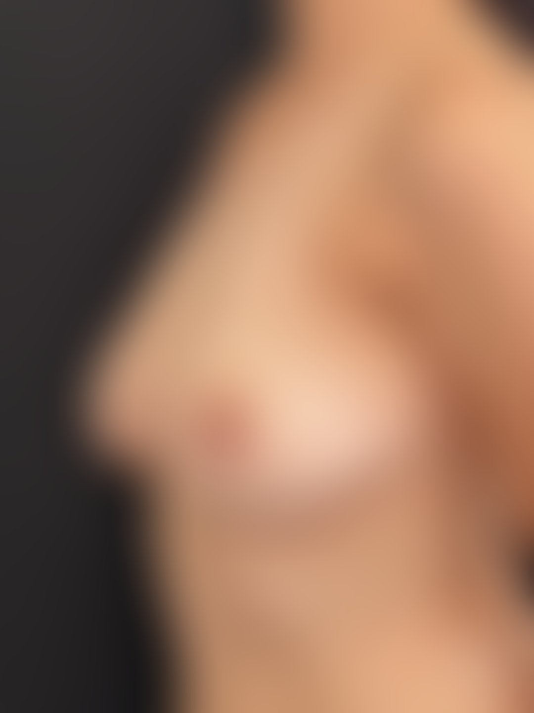 Foto antes de Mastopexia com Prótese (silicone) realizado por Dr. Leandro Akio Tomita