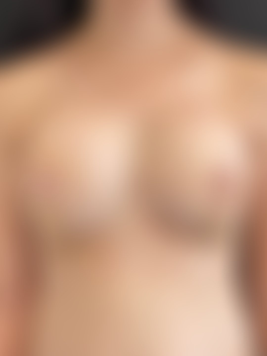 Resultado após Mastopexia com Prótese (silicone) realizado por Dr. Leandro Akio Tomita