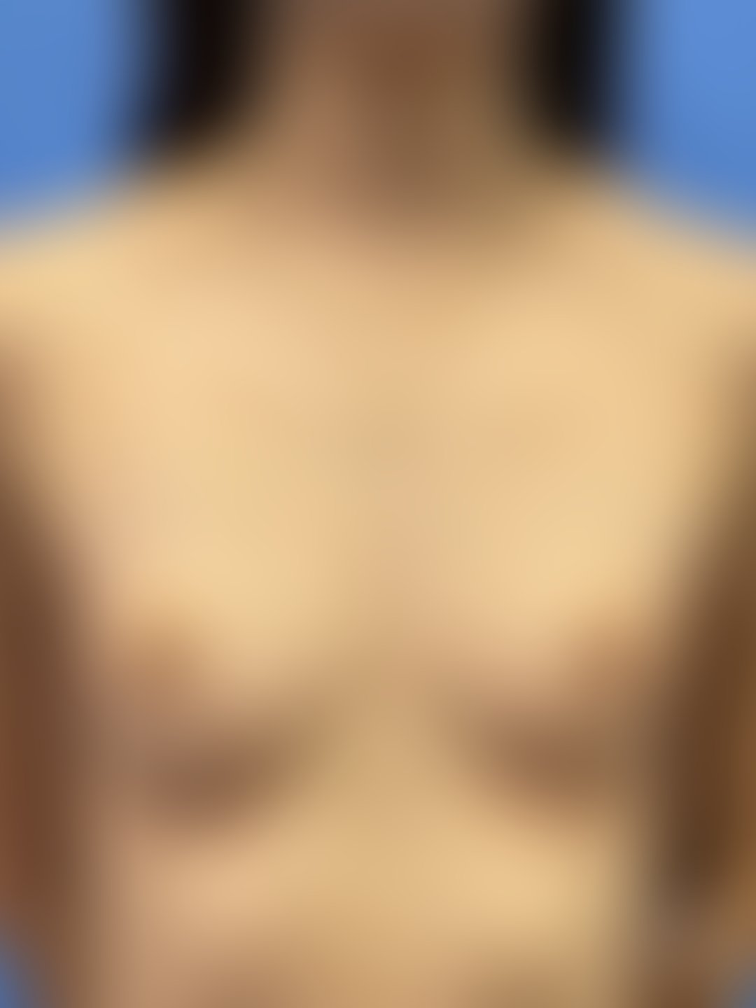 Foto antes de Prótese Mama / Mamoplastia (silicone) realizado por Dr. Henrique Riggenbach Muller