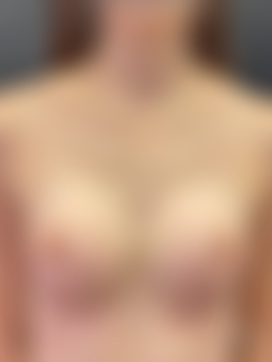 Resultado após Prótese Mama / Mamoplastia (silicone) realizado por Dr. Henrique Riggenbach Muller