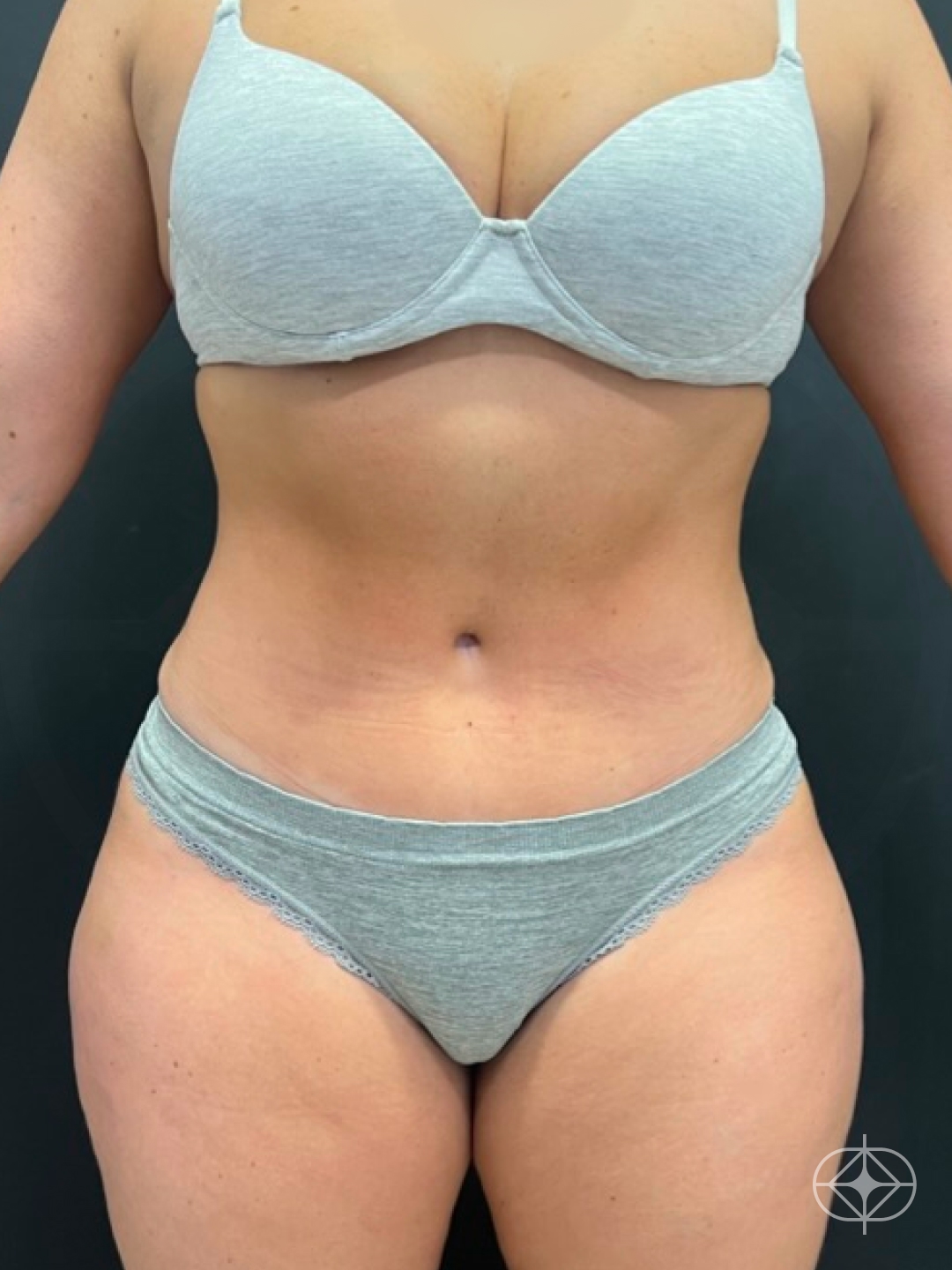 Resultado após Lipoaspiração / Lipo HD realizado por Dr. Felipe de David