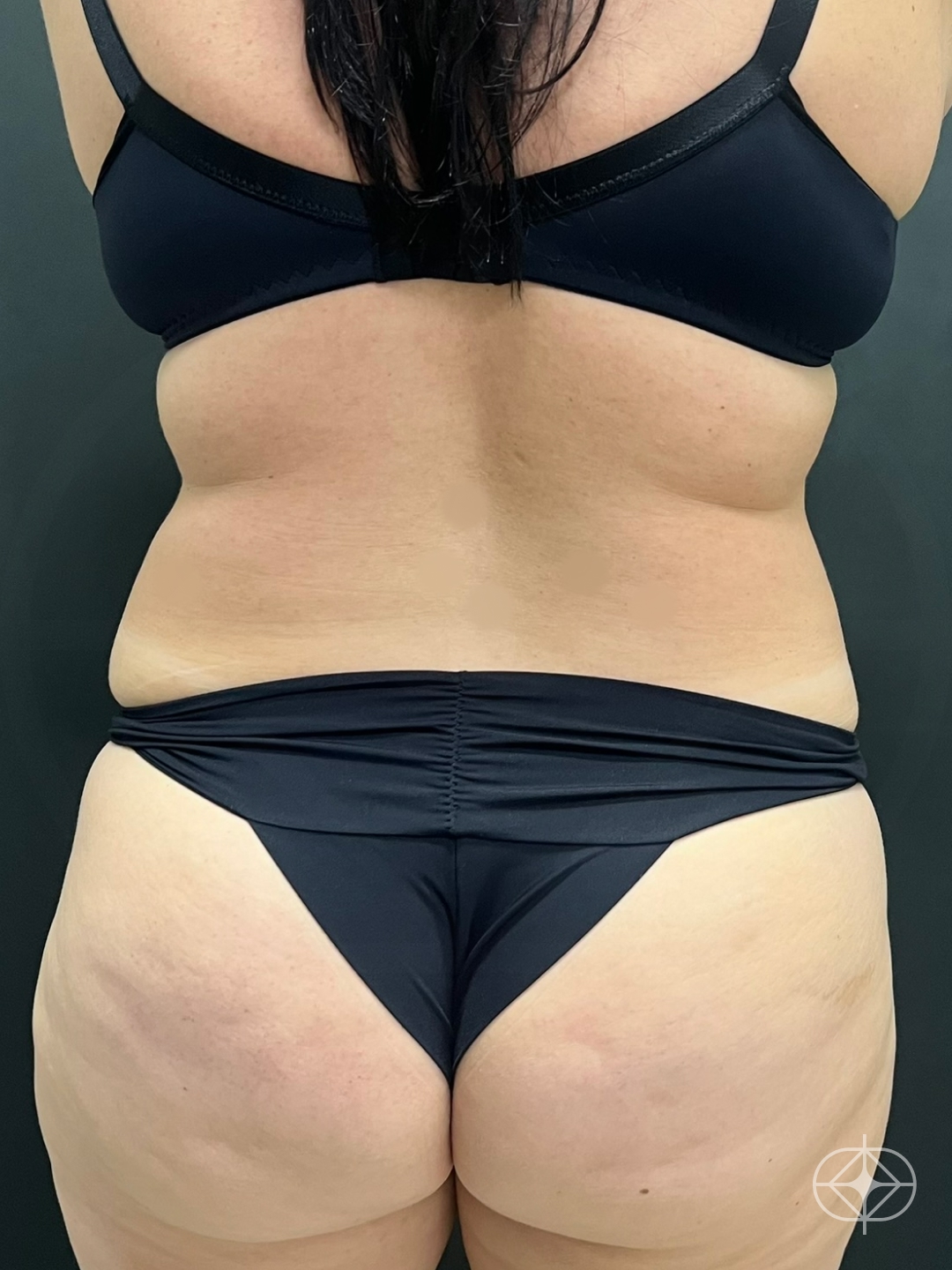 Foto antes de Lipoaspiração / Lipo HD realizado por Dr. Felipe de David