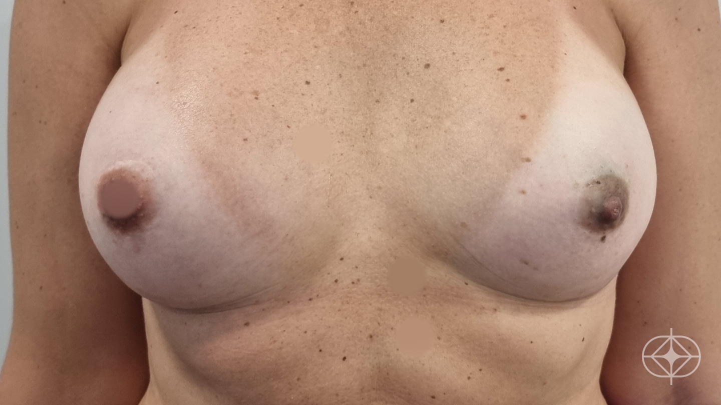 Resultado após Reconstrução Mamária (mastectomia) realizado por Dr. Adriano Oliveira