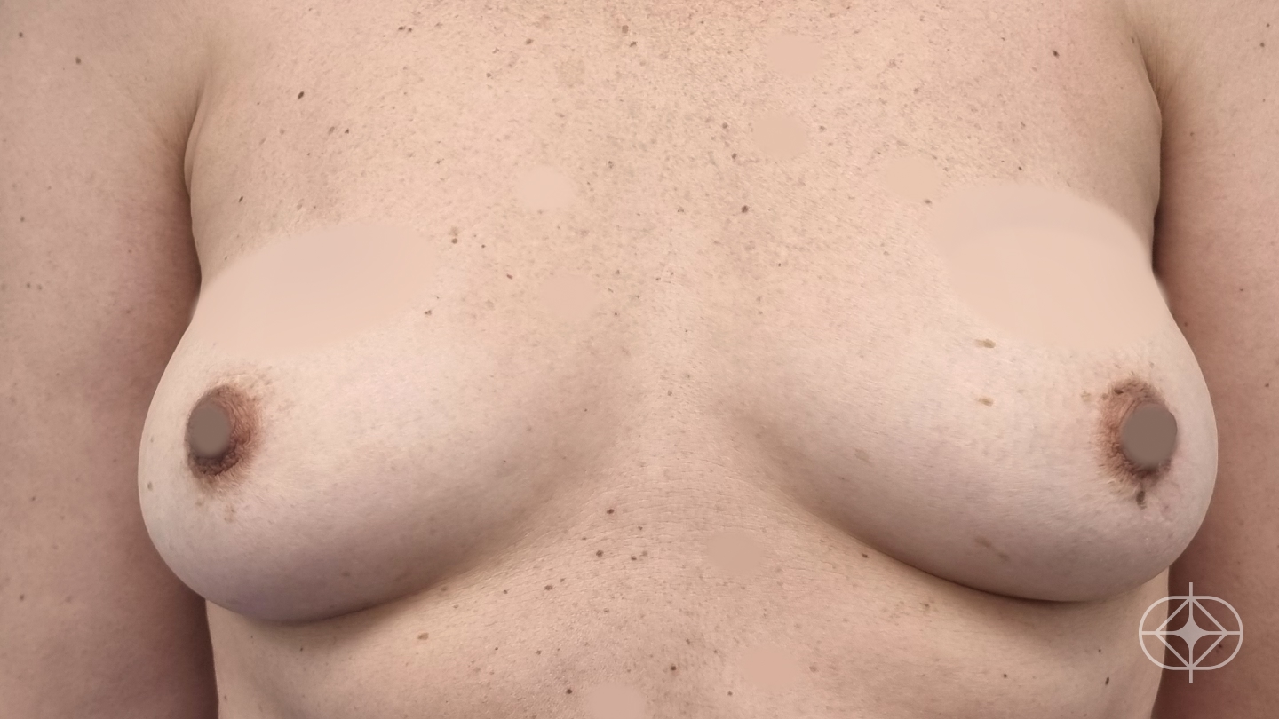 Foto antes de Reconstrução Mamária (mastectomia) realizado por Dr. Adriano Oliveira