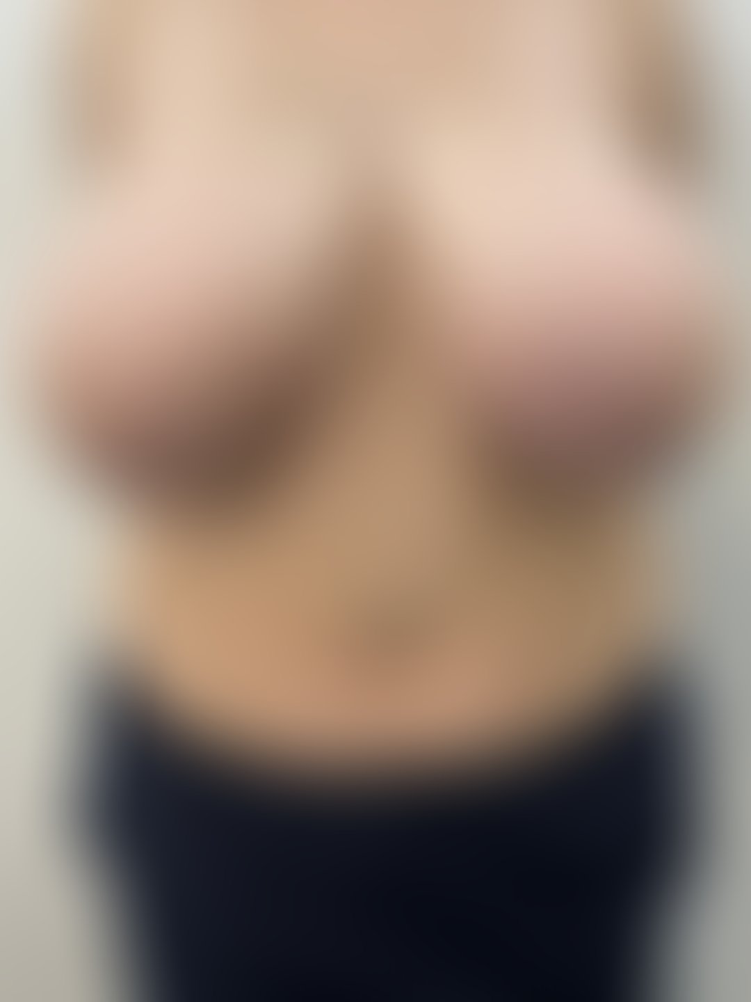 Foto antes de Mamoplastia Redutora realizado por Dra. Monica Renesto Fontana Do Amaral