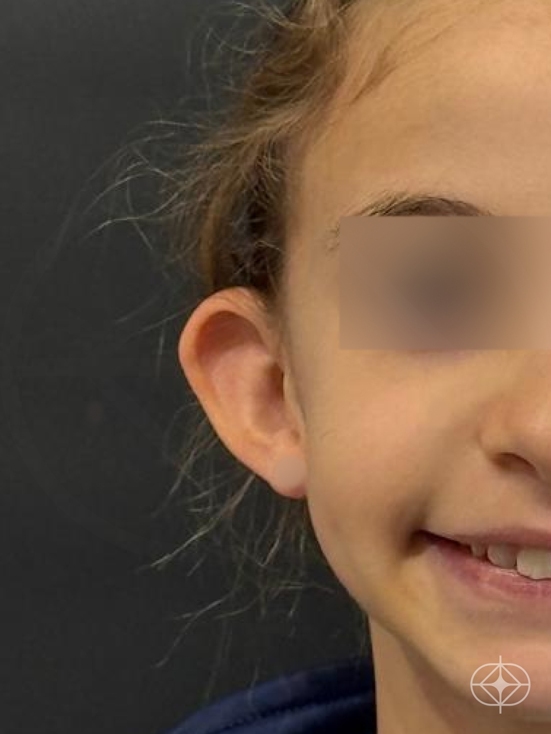 Otoplastia (orelhas) - Pré