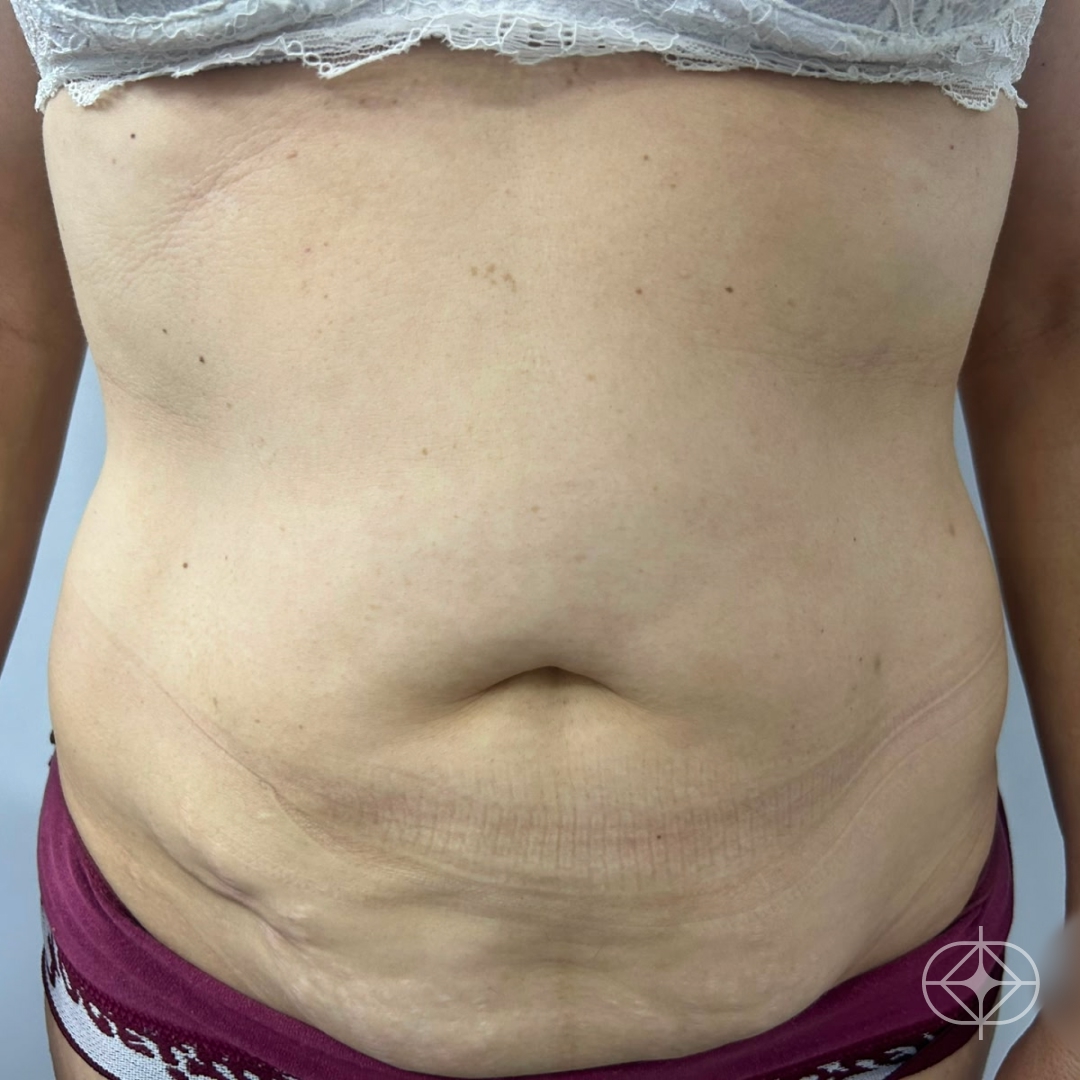 Foto antes de Abdominoplastia realizado por Dr. Renato Saliba Donatelli