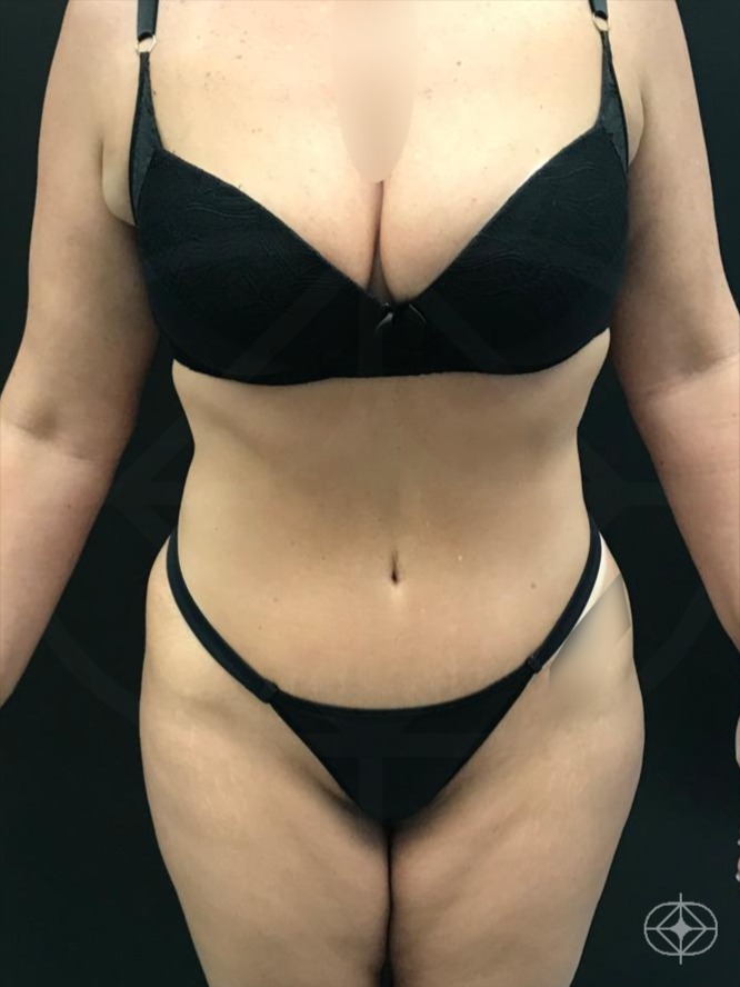 Resultado após Abdominoplastia realizado por Dr. William Seidel