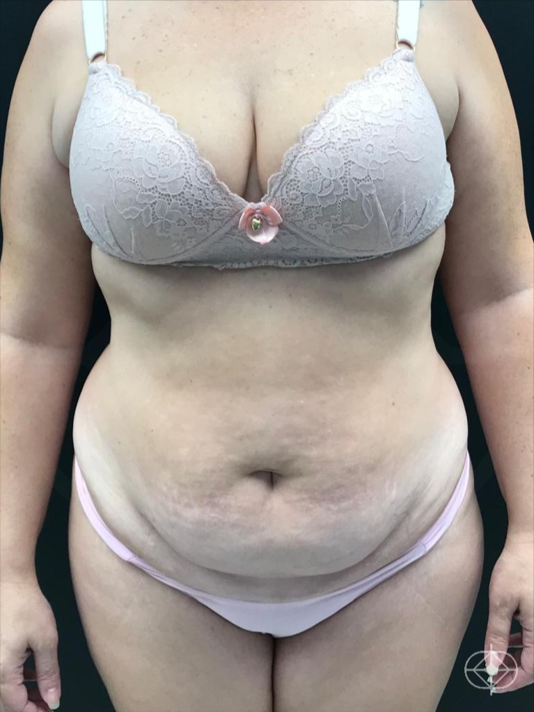 Foto antes de Abdominoplastia realizado por Dr. William Seidel