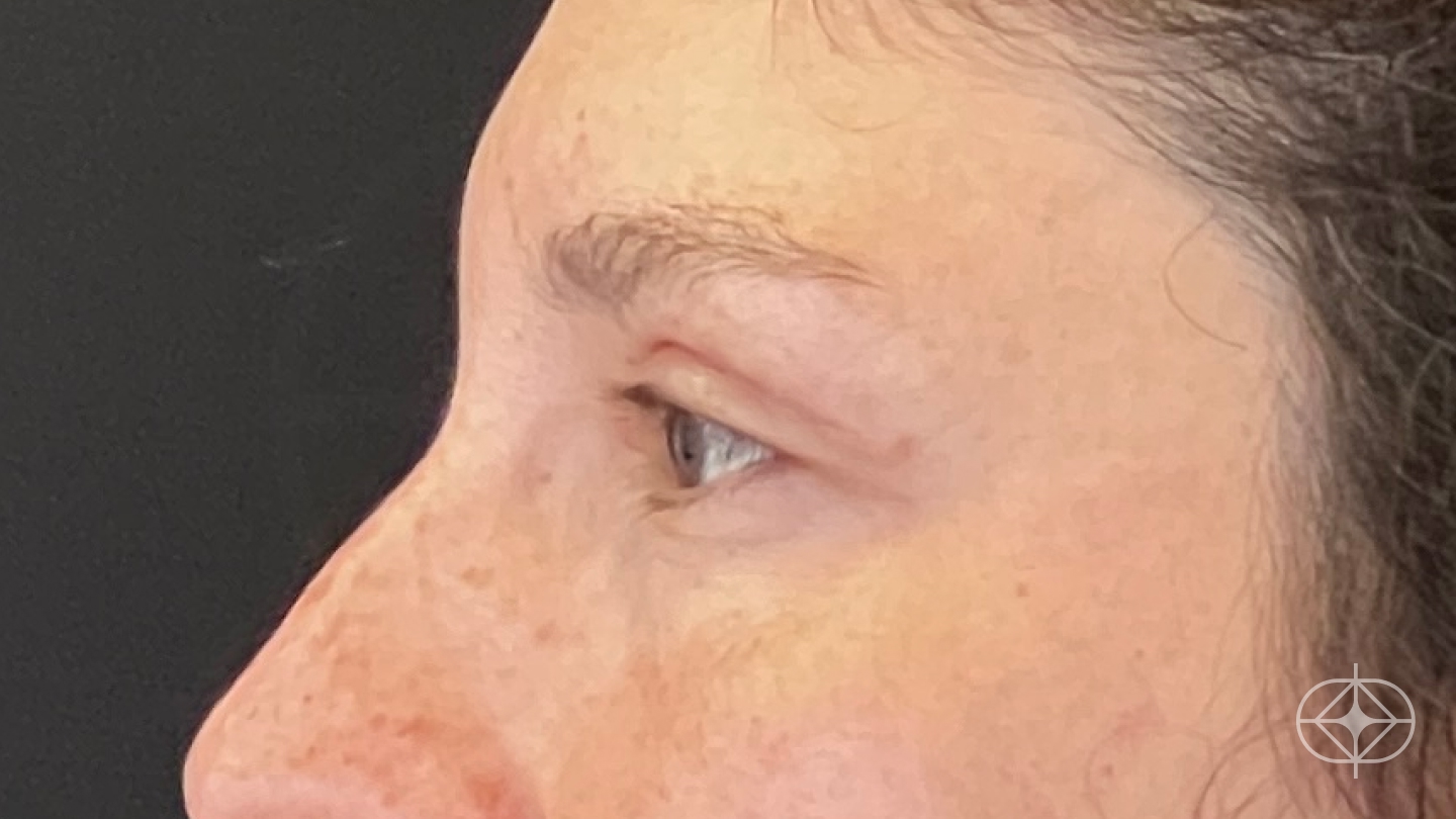 Resultado após Blefaroplastia (olhos) realizado por Dr. Leandro Akio Tomita