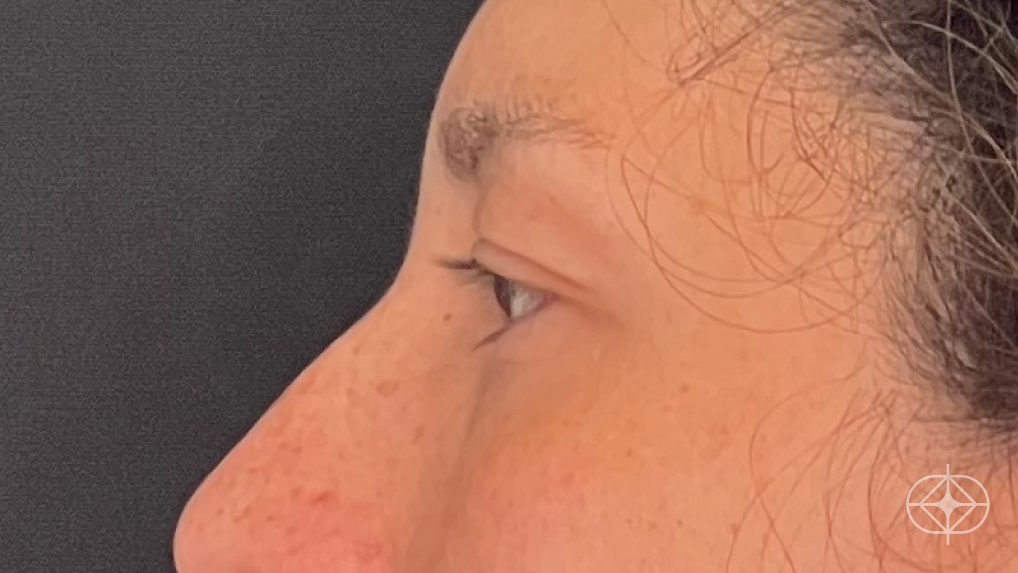 Foto antes de Blefaroplastia (olhos) realizado por Dr. Leandro Akio Tomita