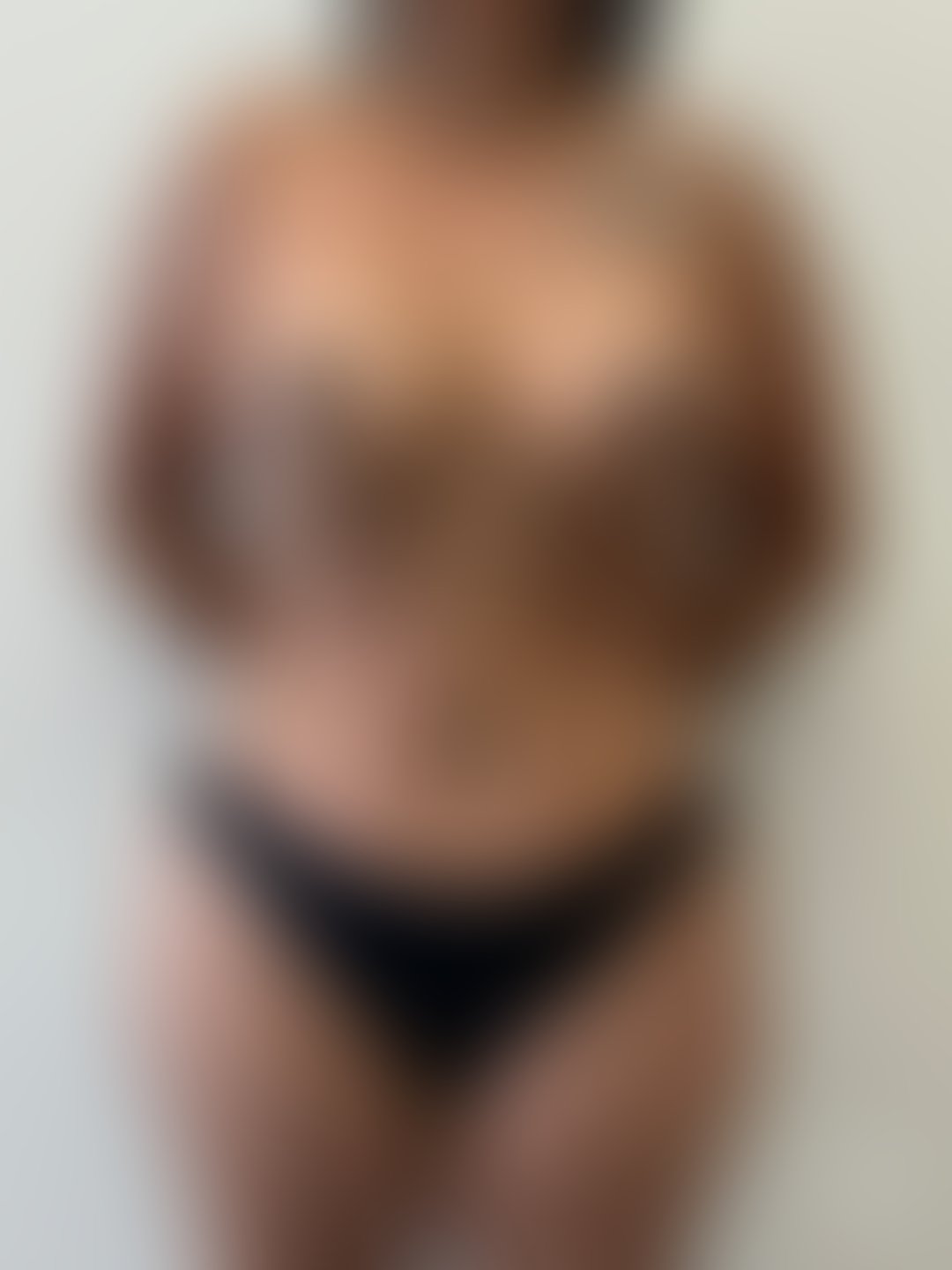 Resultado após Mastopexia sem Prótese realizado por Dr. João Ferreira