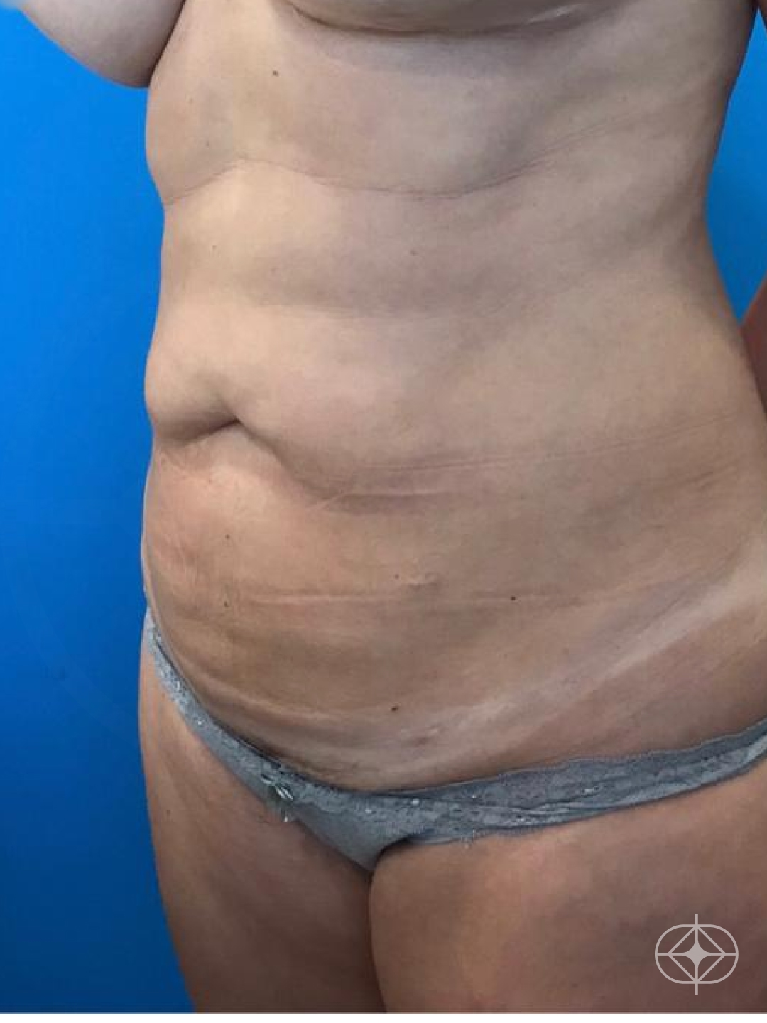 Foto antes de Abdominoplastia realizado por Dr. Igor Rocha