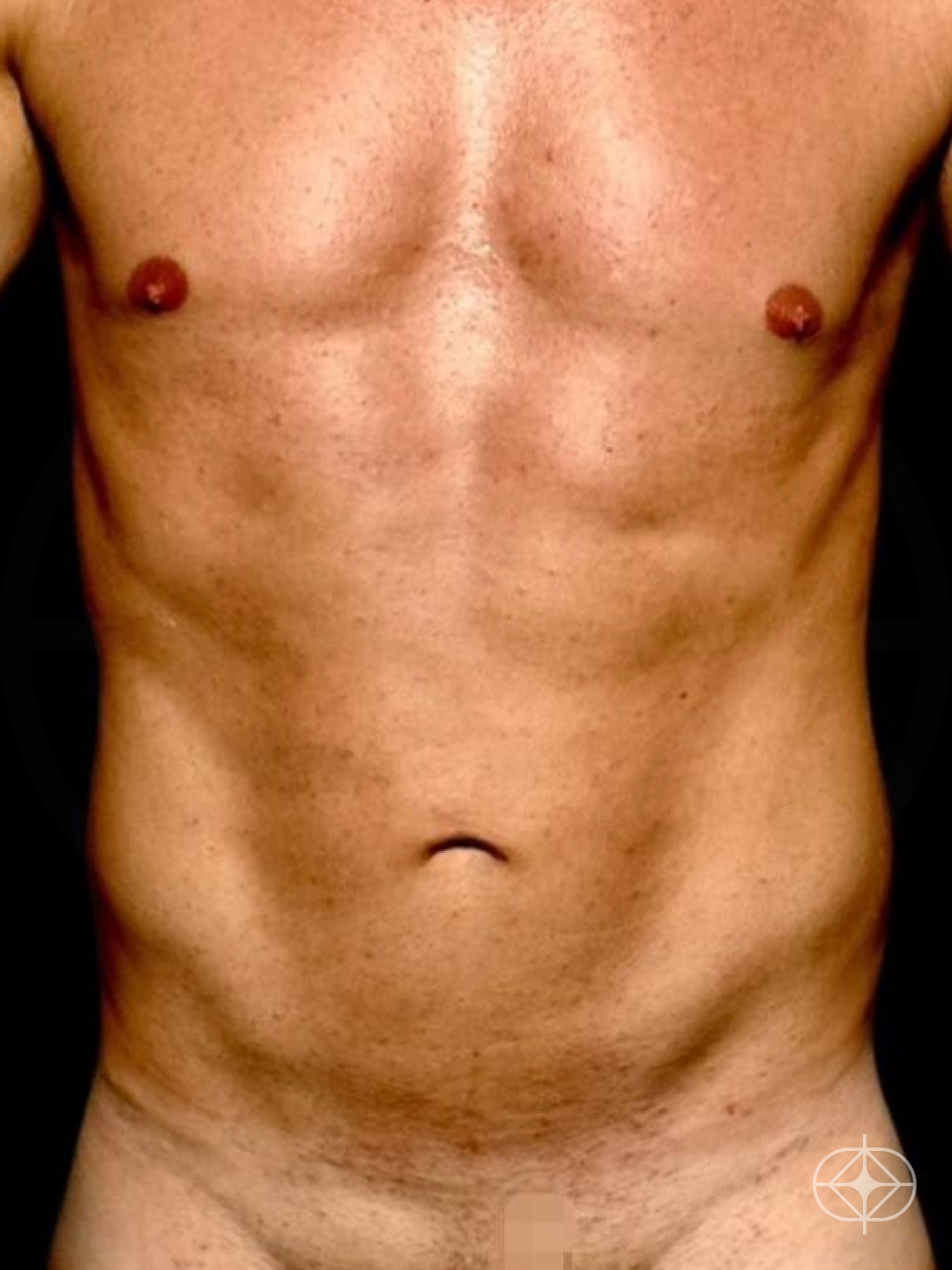 Resultado após Lipoaspiração / Lipo HD realizado por Dr. Edgar Lopez Campos
