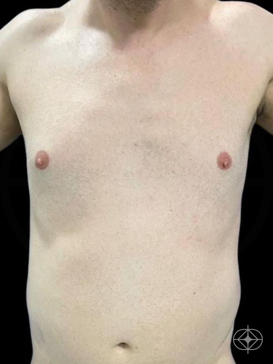 Foto antes de Lipoaspiração / Lipo HD realizado por Dr. Edgar Lopez Campos