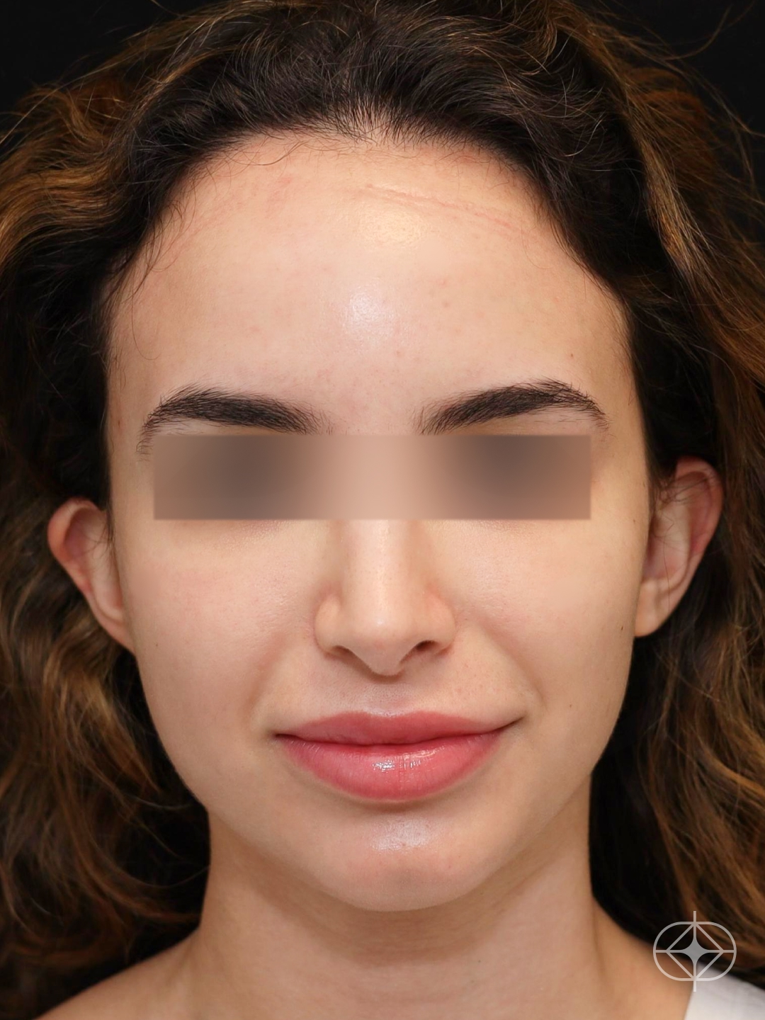 Foto antes de Otoplastia (orelhas) realizado por Dr. Eduardo Zomer