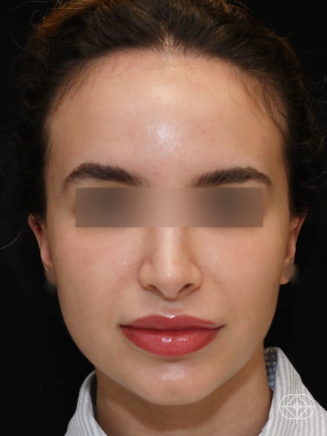 Resultado após Otoplastia (orelhas) realizado por Dr. Eduardo Zomer