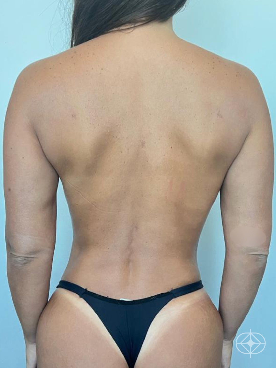 Resultado após Lipoaspiração / Lipo HD realizado por Dr. Igor Rocha