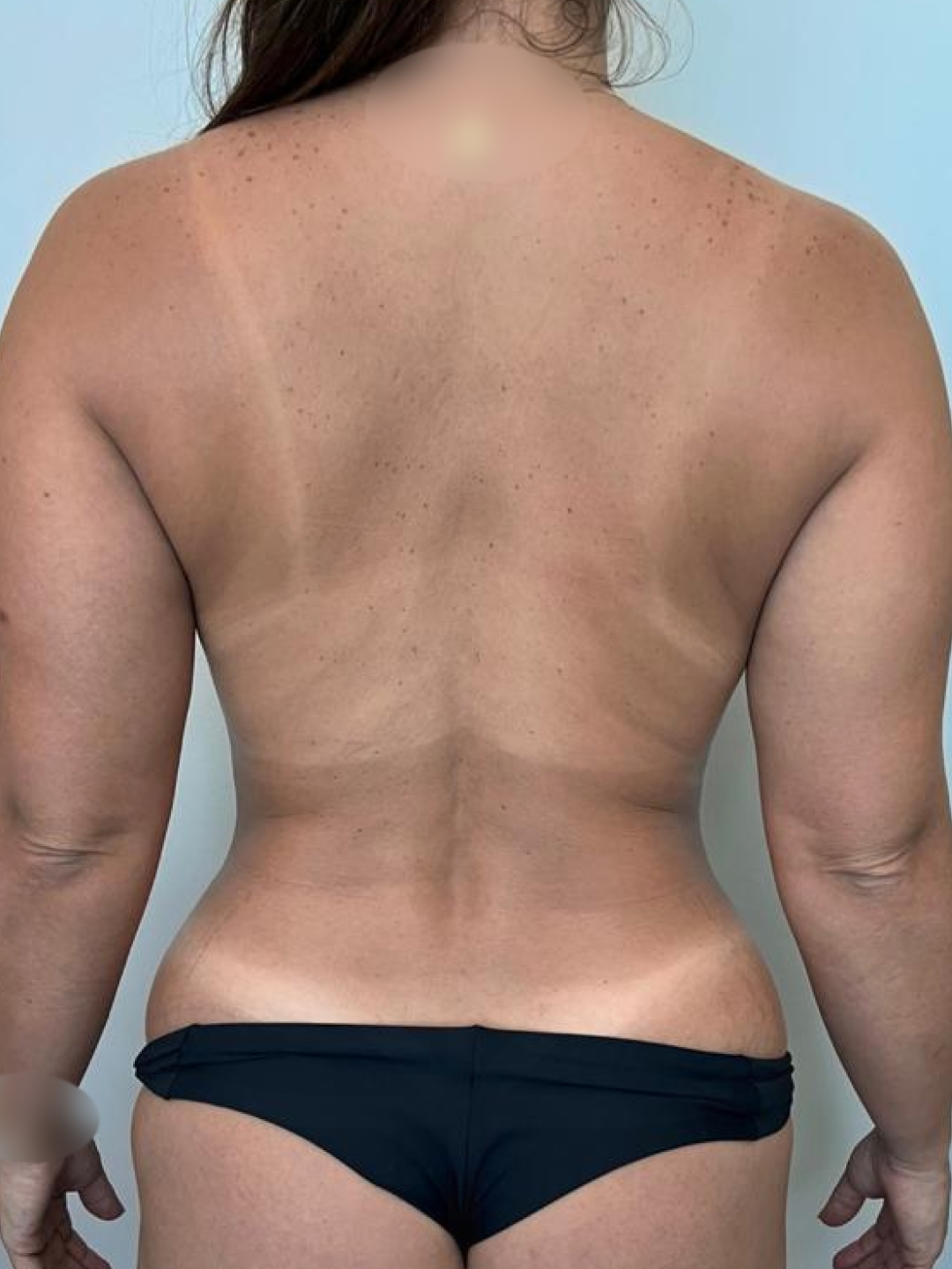 Foto antes de Lipoaspiração / Lipo HD realizado por Dr. Igor Rocha