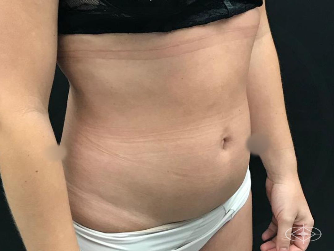 Foto antes de Lipoaspiração / Lipo HD realizado por Dr. William Seidel