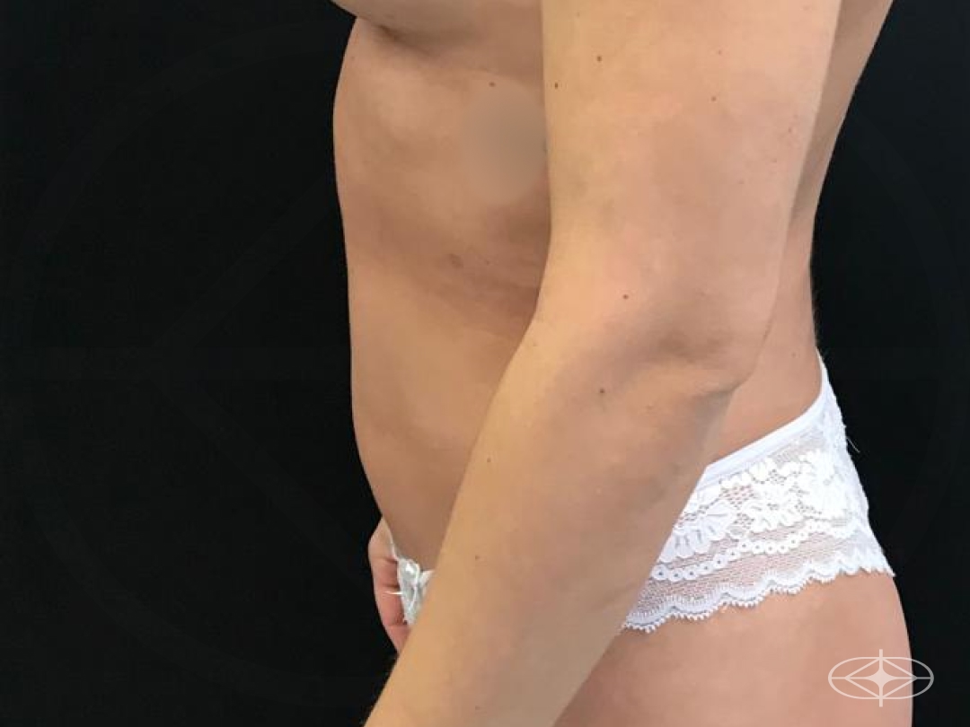 Resultado após Lipoaspiração / Lipo HD realizado por Dr. William Seidel