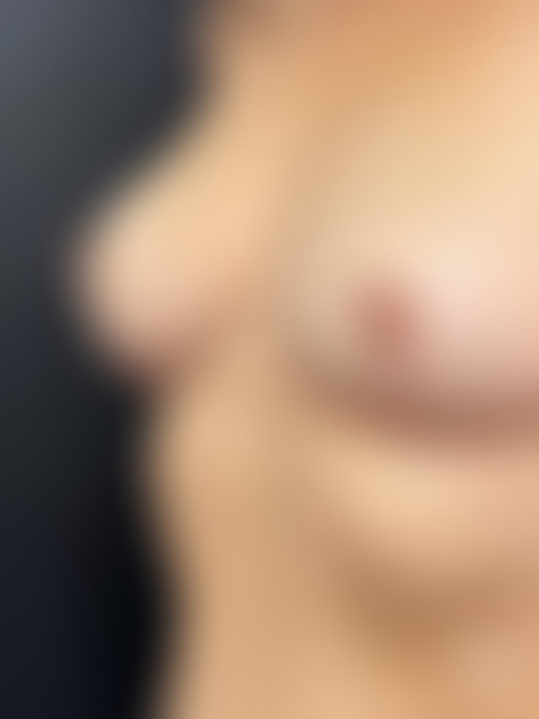 Resultado após Mamoplastia Redutora realizado por Dra. Monica Renesto Fontana Do Amaral