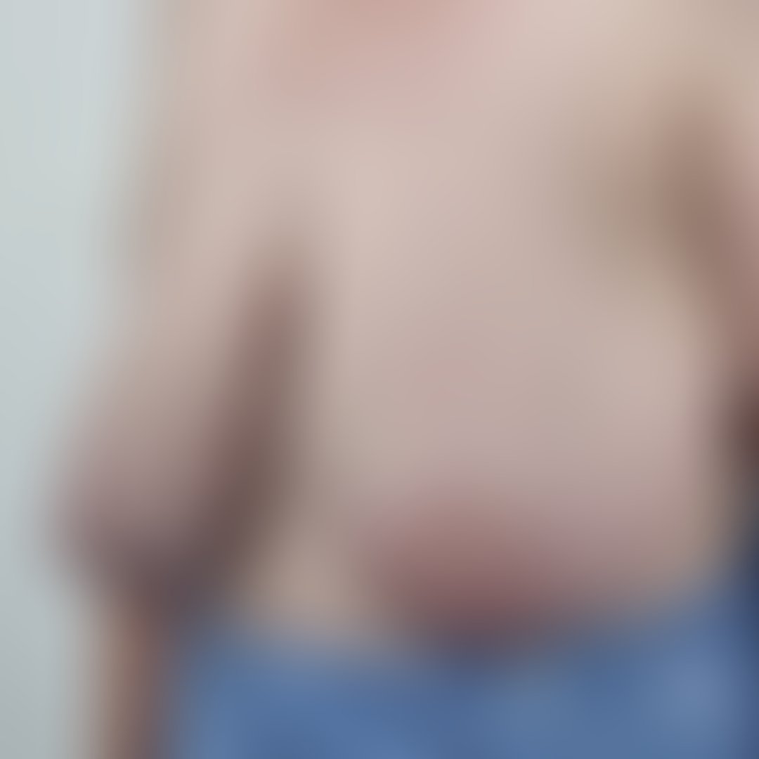 Foto antes de Mamoplastia Redutora realizado por Dr. Adriano Oliveira