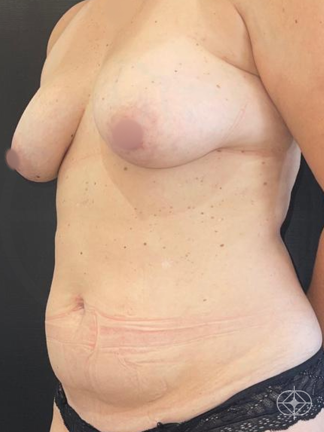 Foto antes de Abdominoplastia realizado por Dra. Monica Renesto Fontana Do Amaral