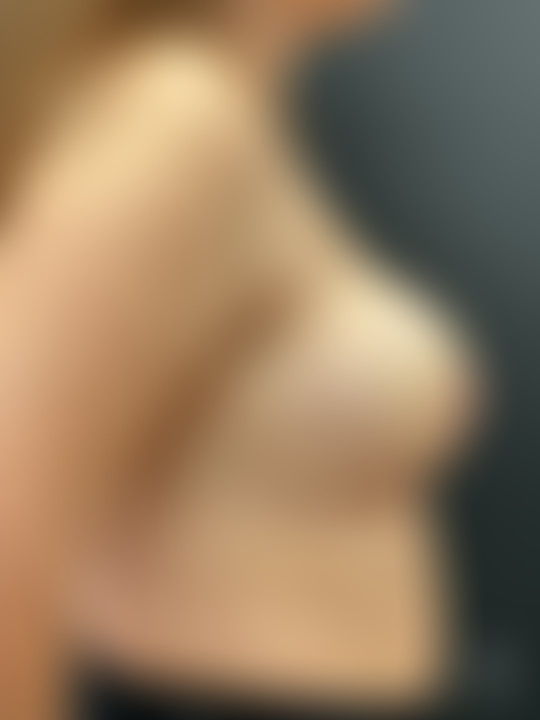 Resultado após Explante / Remoção de Silicone realizado por Dr. Henrique Riggenbach Muller