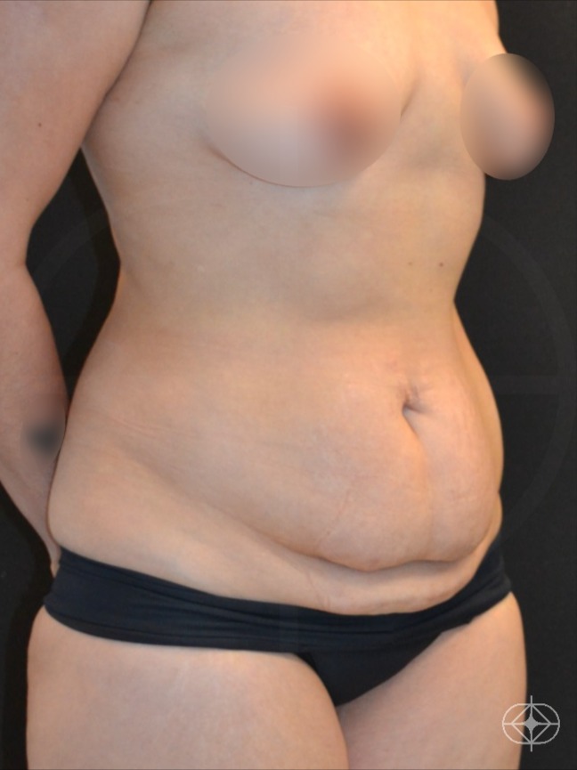 Foto antes de Abdominoplastia realizado por Dr. Rubem Bottas