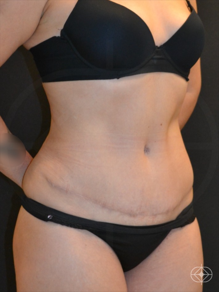 Resultado após Abdominoplastia realizado por Dr. Rubem Bottas