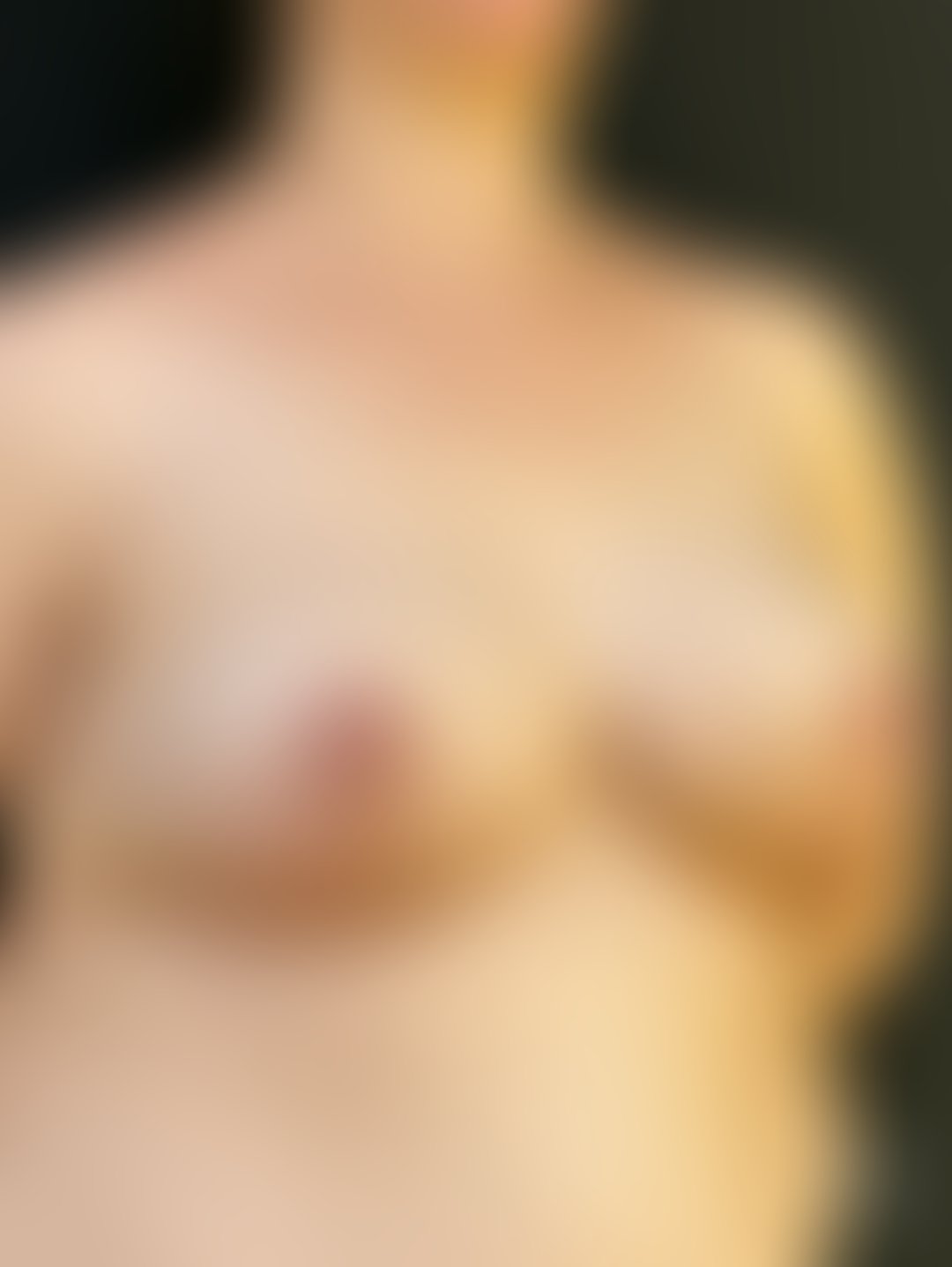 Resultado após Mamoplastia Redutora realizado por Dr. Henrique Riggenbach Muller