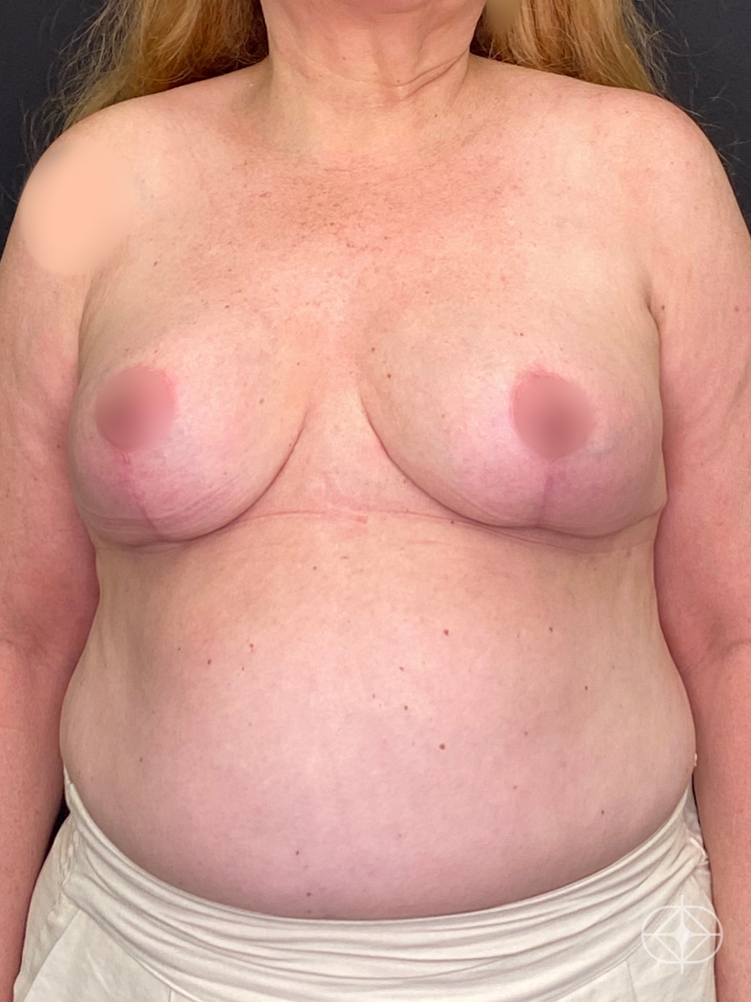 Resultado após Mamoplastia Redutora realizado por Dr. Leandro Akio Tomita