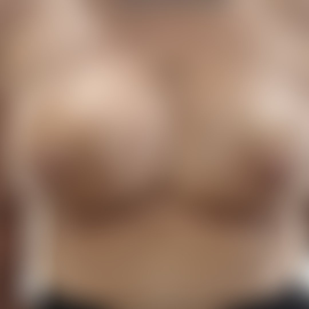 Resultado após Mamoplastia Redutora realizado por Dr. Adriano Oliveira
