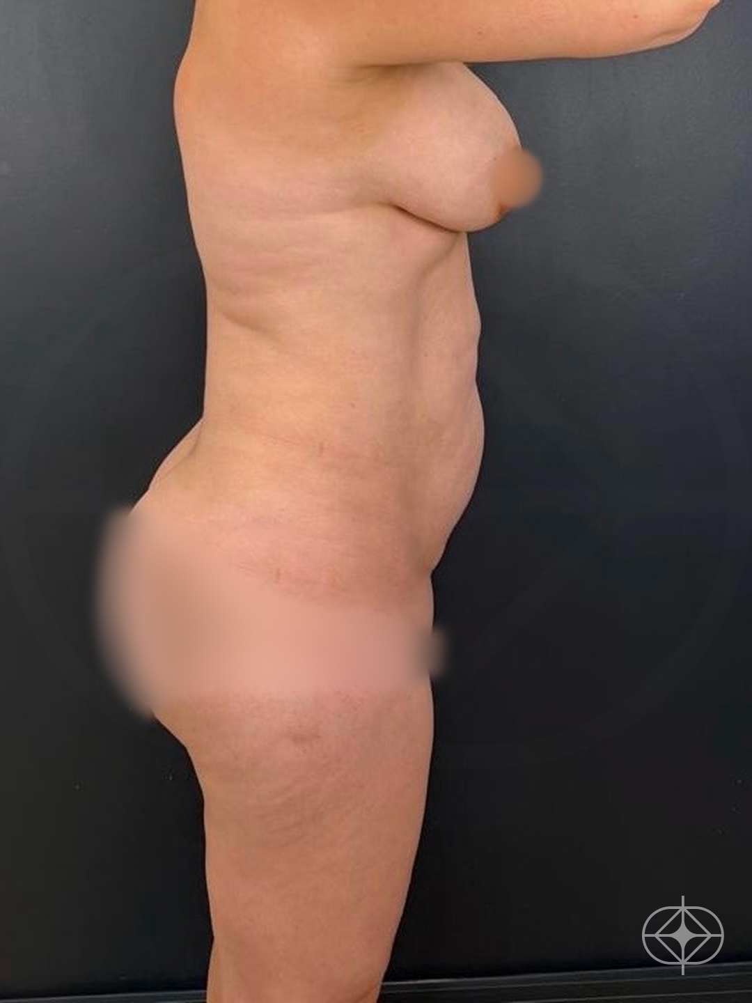 Foto antes de Abdominoplastia realizado por Dr. Luis Fernando Bacarin