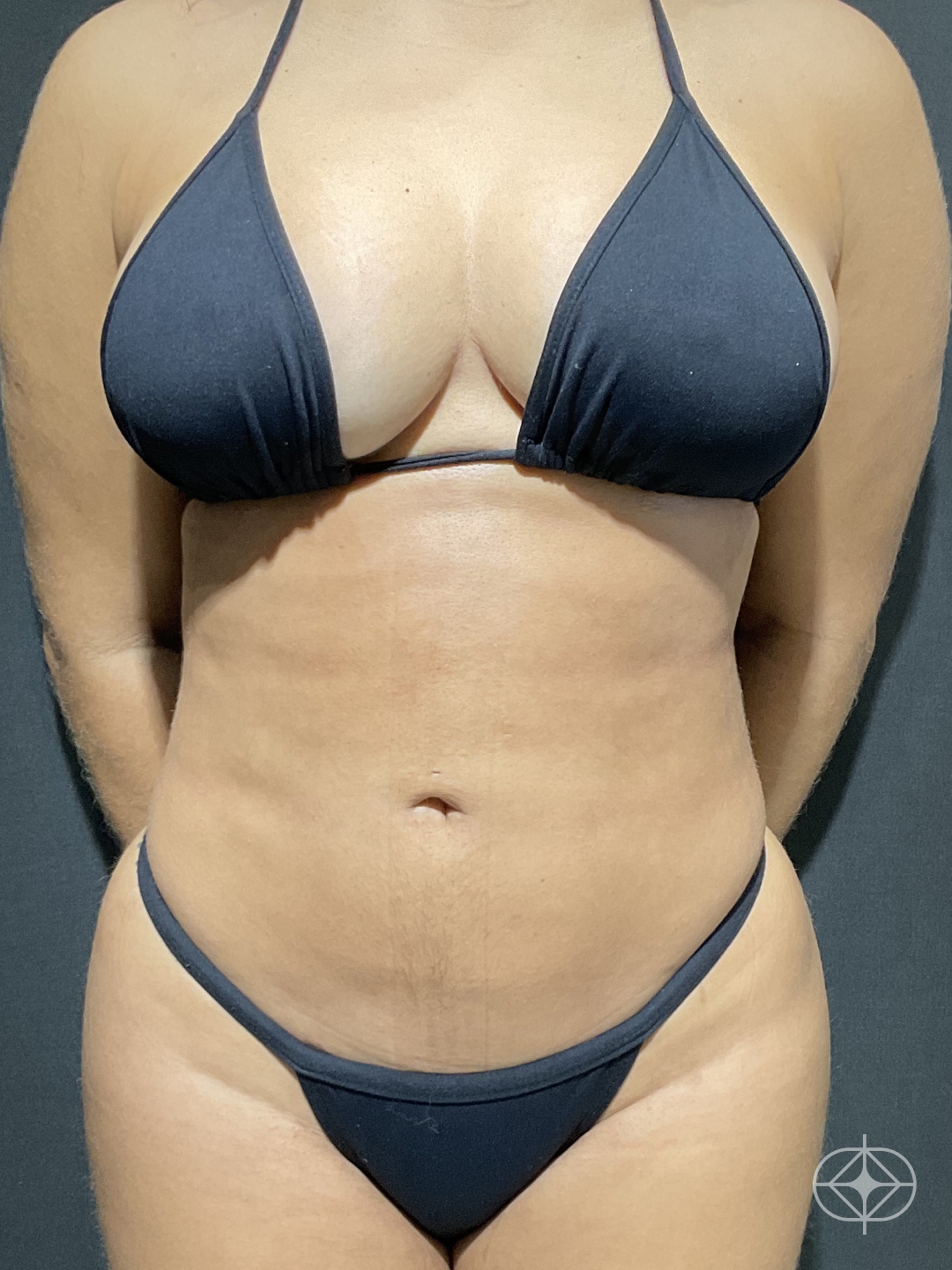 Resultado após Lipoaspiração / Lipo HD realizado por Dr. Thiago Tubone