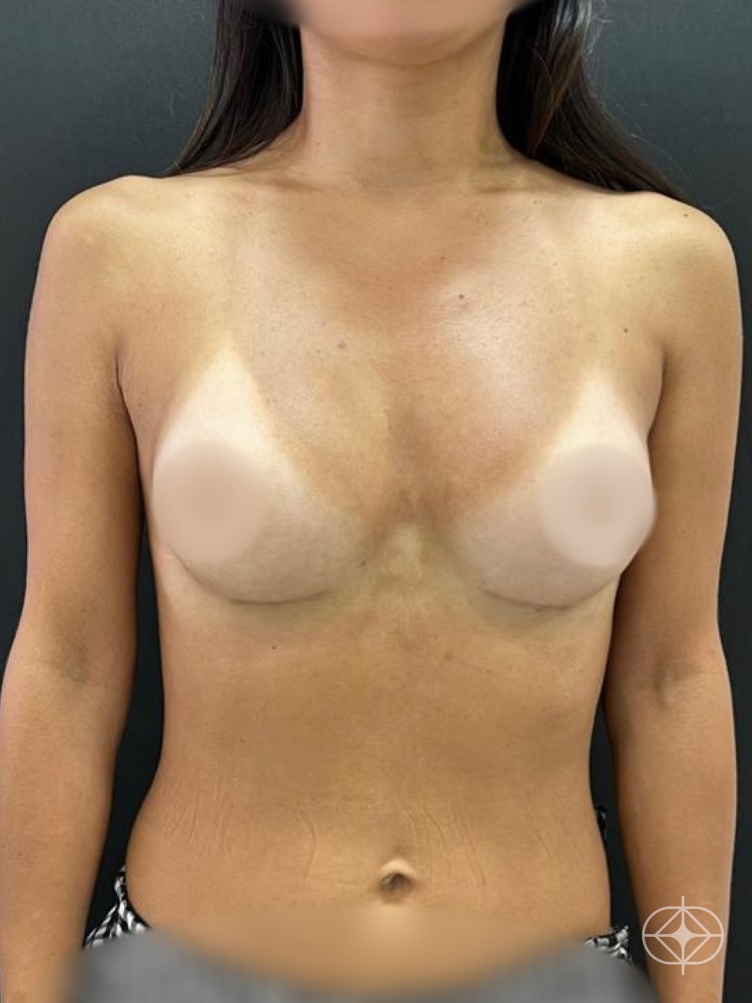 Resultado após Prótese Mama / R24R (silicone) realizado por Dr. Ricardo Westphal