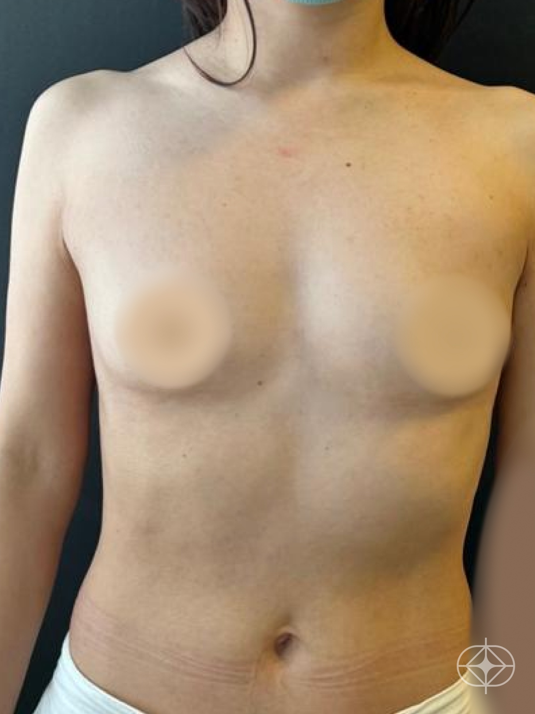 Foto antes de Prótese Mama / R24R (silicone) realizado por Dr. Ricardo Westphal