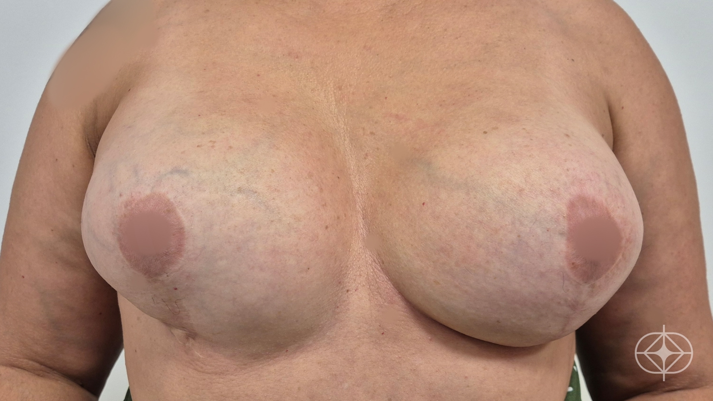 Resultado após Reconstrução Mamária (mastectomia) realizado por Dr. Adriano Oliveira