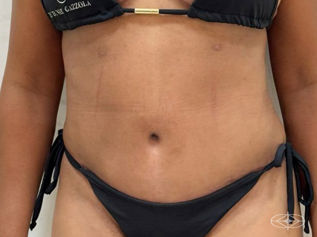 Resultado após Lipoaspiração / Lipo HD realizado por Dr. Daniel Gazzola