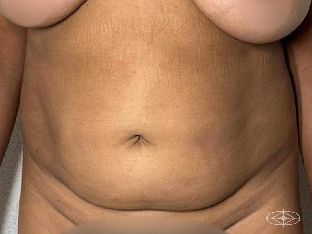 Foto antes de Lipoaspiração / Lipo HD realizado por Dr. Daniel Gazzola