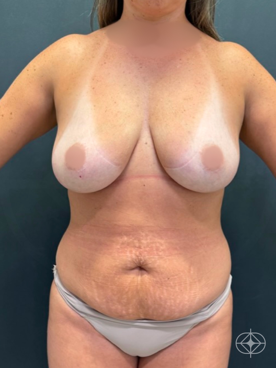 Foto antes de Abdominoplastia realizado por Dr. Felipe de David