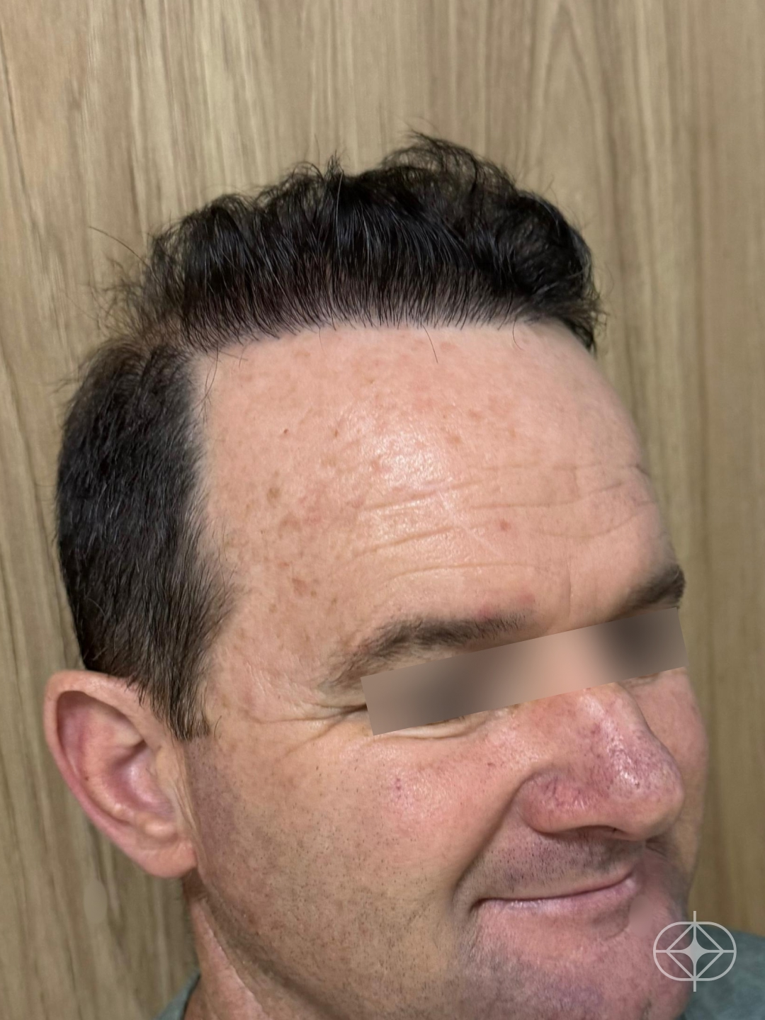 Resultado após Transplante Capilar (cabelo) realizado por Dr. Mohamed Najmeddine