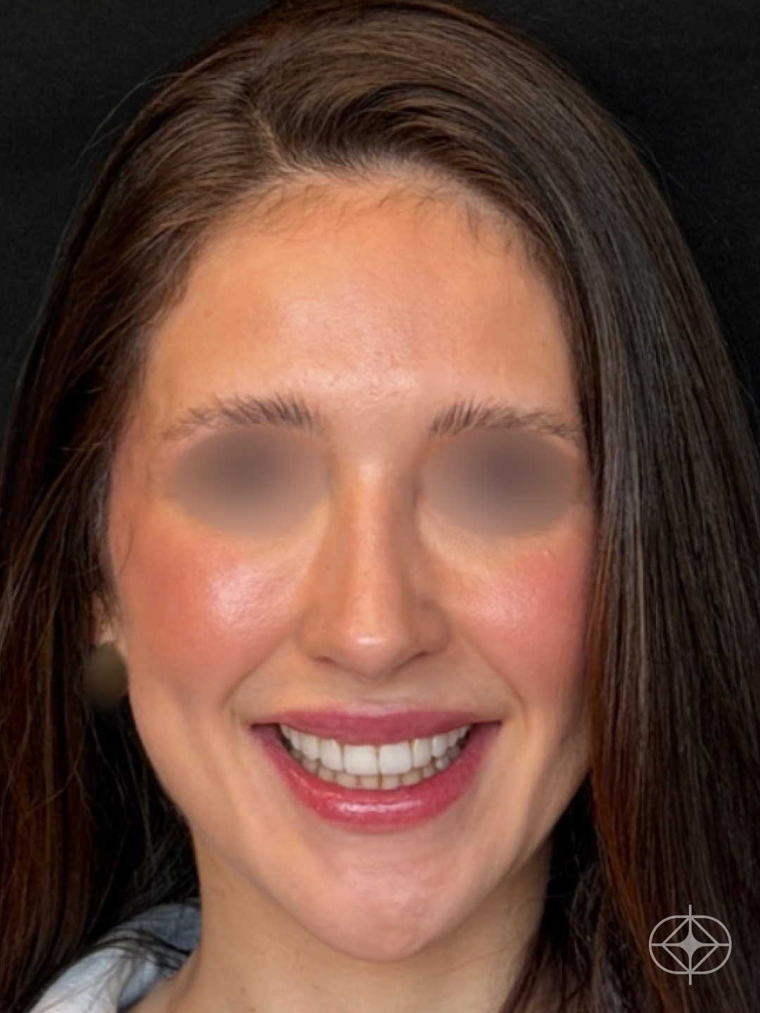 Resultado após Rinoplastia (nariz) realizado por Dr. Eduardo Zomer
