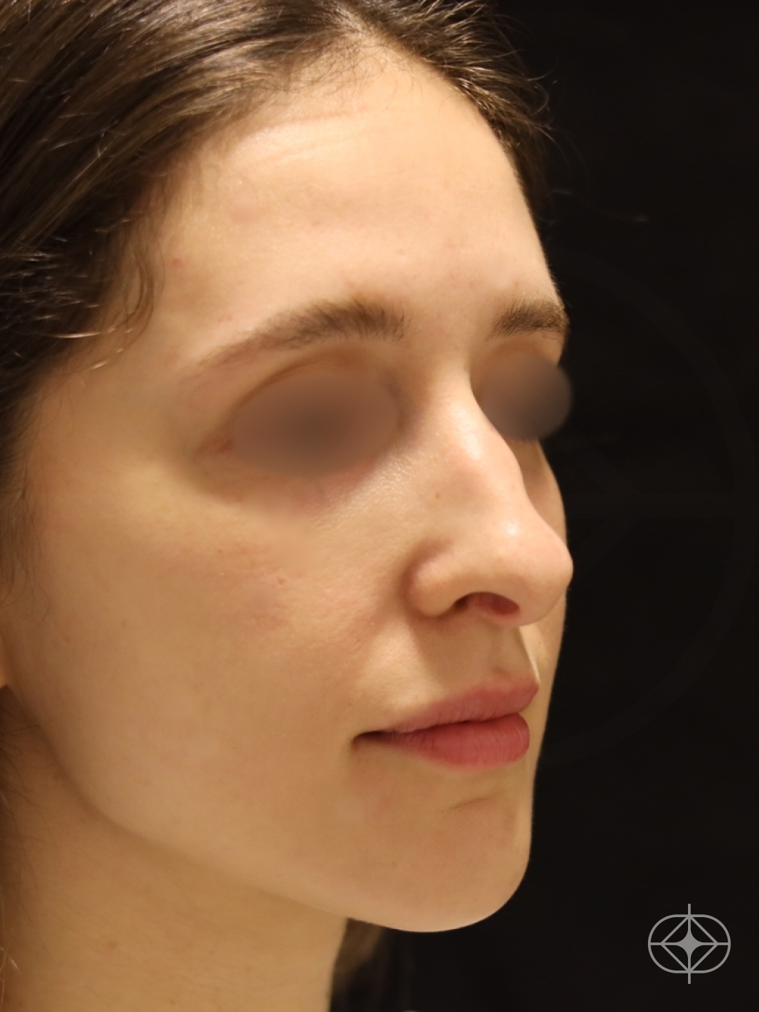 Foto antes de Rinoplastia (nariz) realizado por Dr. Eduardo Zomer