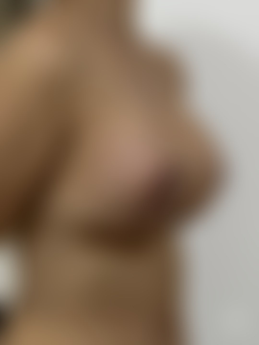 Resultado após Mastopexia com Prótese (silicone) realizado por Dr. João Ferreira